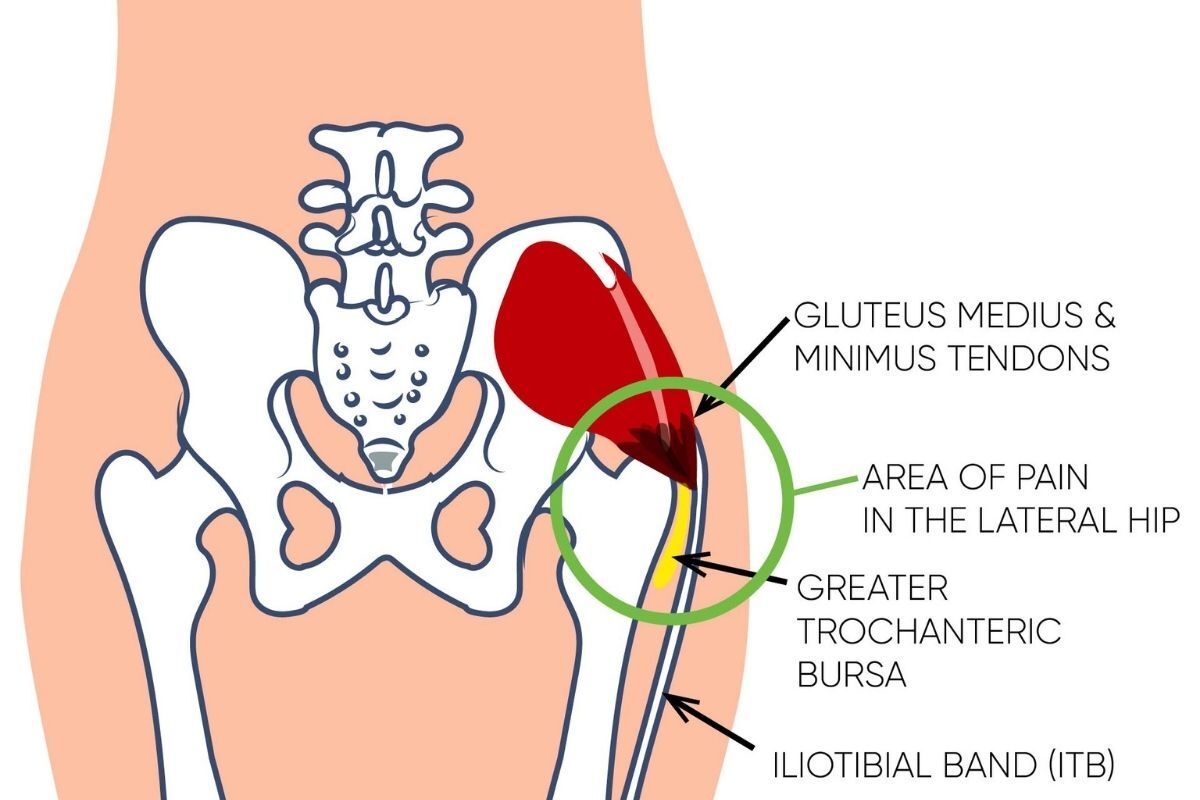 Got hip pain from running Fix it with advice from a ...